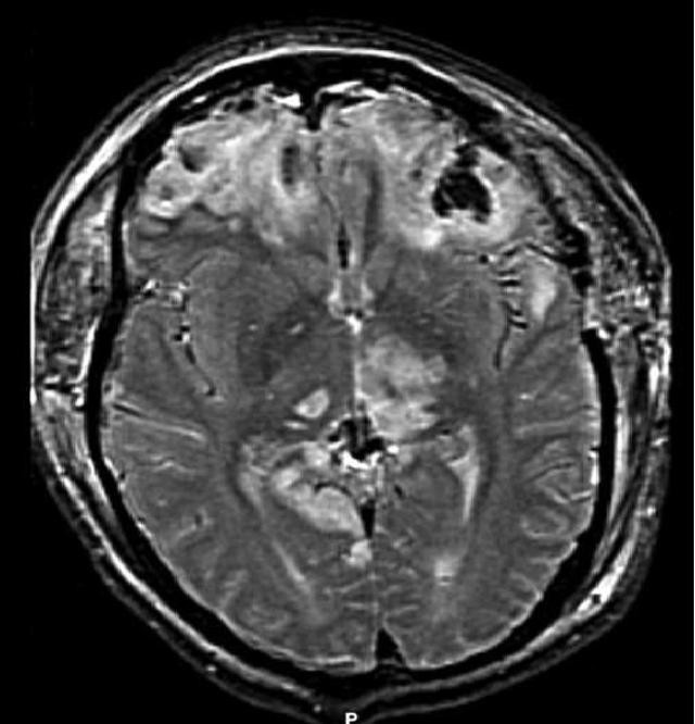 Lasting Effects of a Brain Injury