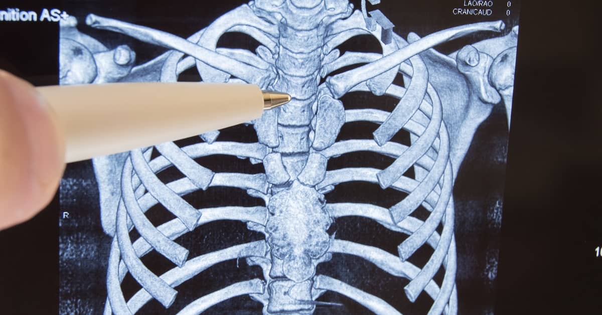 Doctor holding a pen pointing to the x ray of Spinal cord Injury