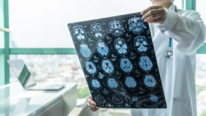 A doctor reviewing X-rays of a brain